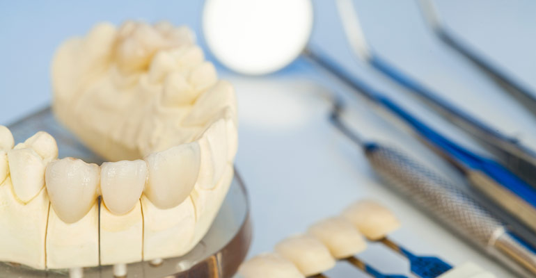 Dental Crowns Vs Fillings