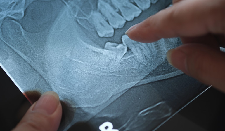Do You Really Need Your Wisdom Teeth Removed