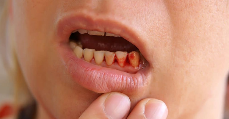 How Stop Gums Bleeding