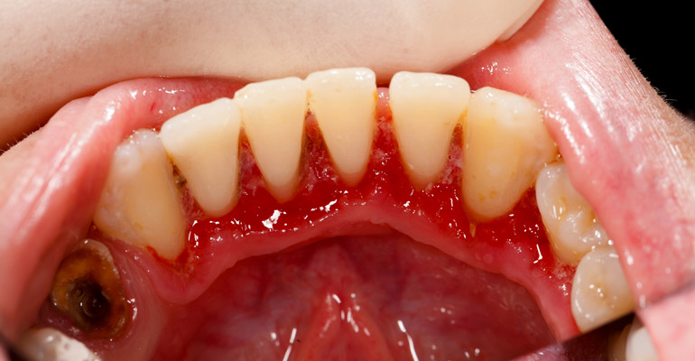 How Treat Gum Disease