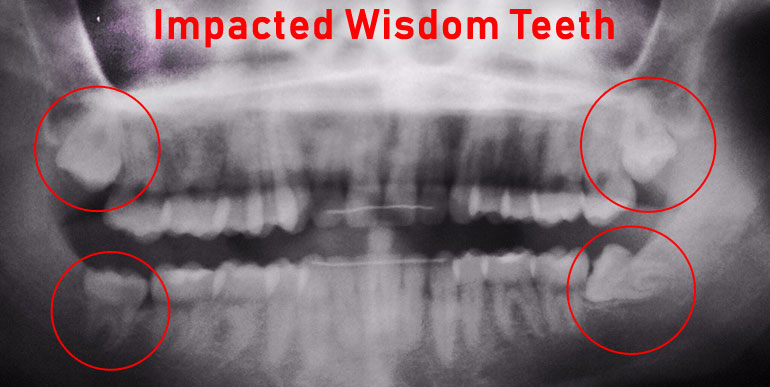 impacted wisdom teeth