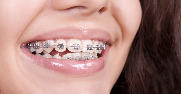 keeping-your-teeth-healthy-while-you-have-braces