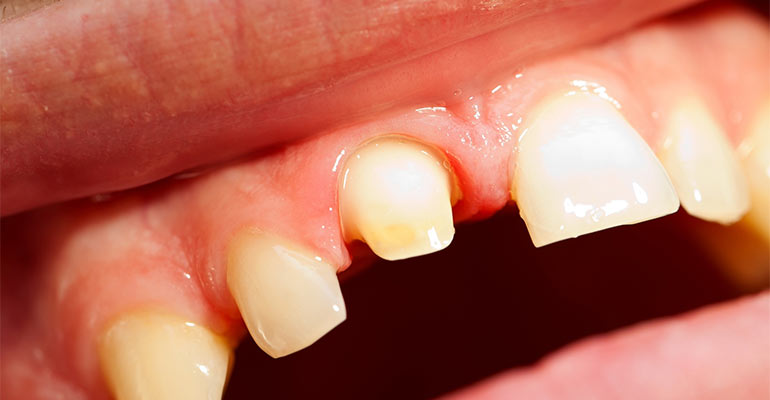 lost tooth crown