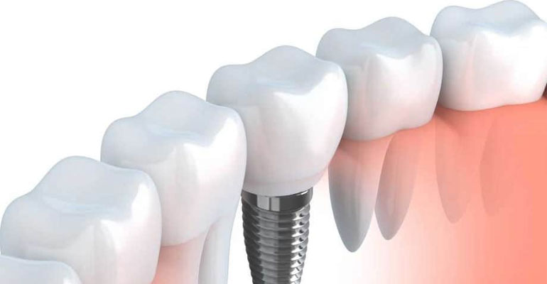 partial-dentures-or-denture-implants-which-one-is-best-for-me