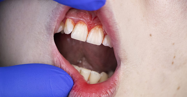 Periodontal Disease