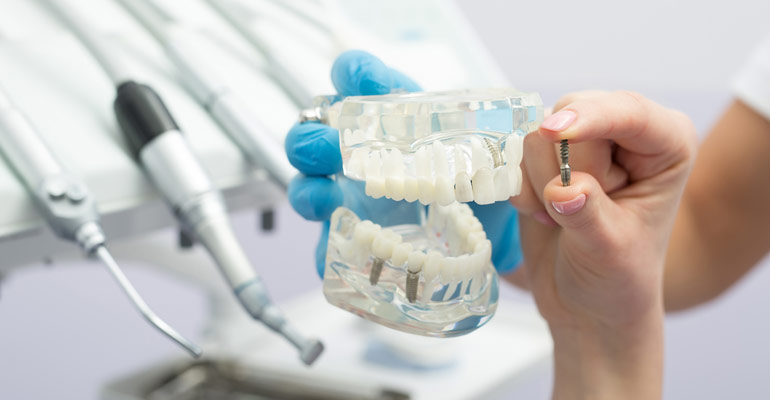 reasons choose dental implants toronto