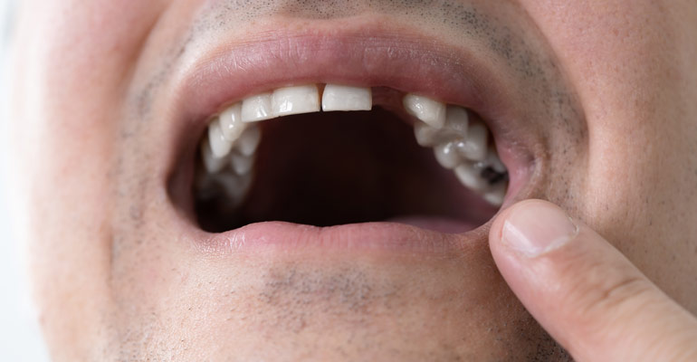 Right Candidates For Dental Implants