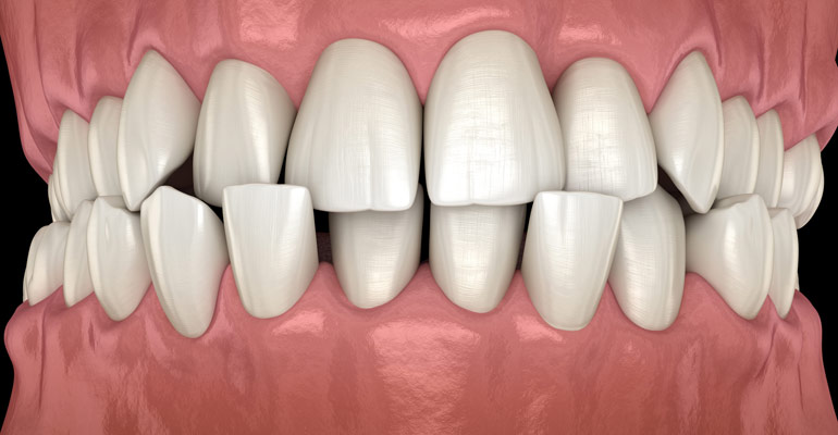 Side Effects Misaligned Teeth