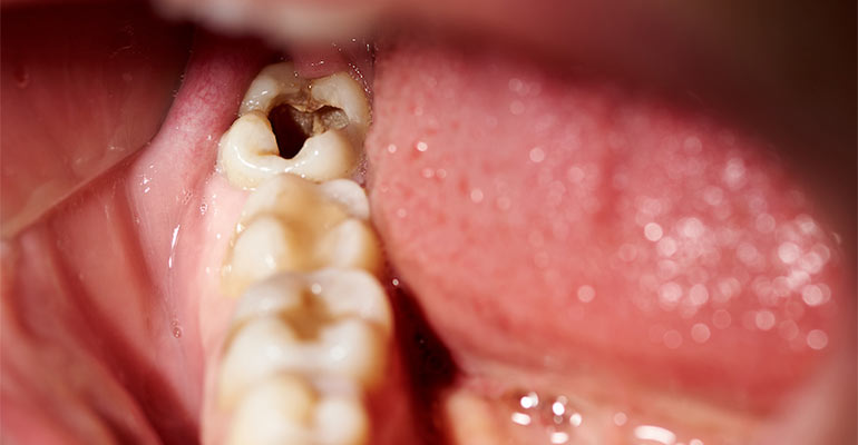 tooth cavities