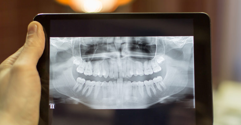 tooth extraction reasons