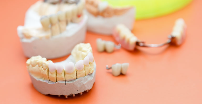 transitioning from dentures to dental implants