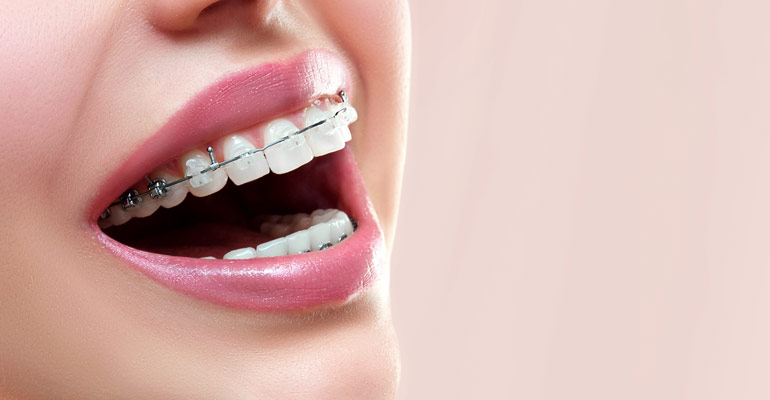 Types Of Braces Pros And Cons