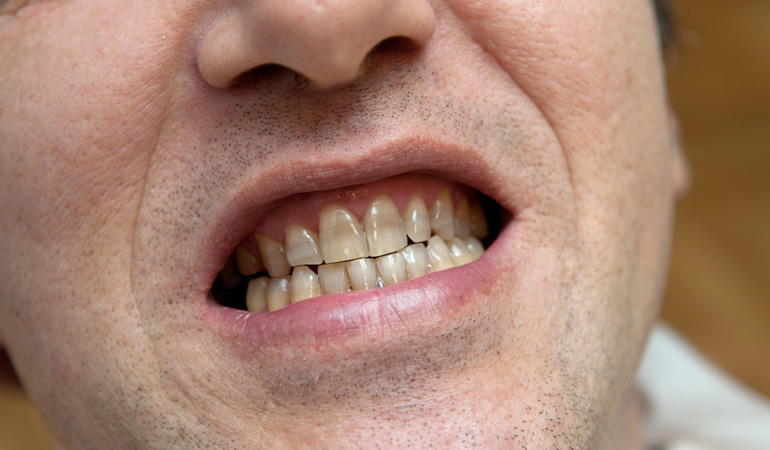 Understanding What Causes Teeth Staining And How Prevent It