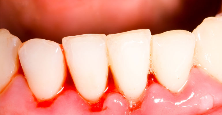 why-are-my-gums-bleeding