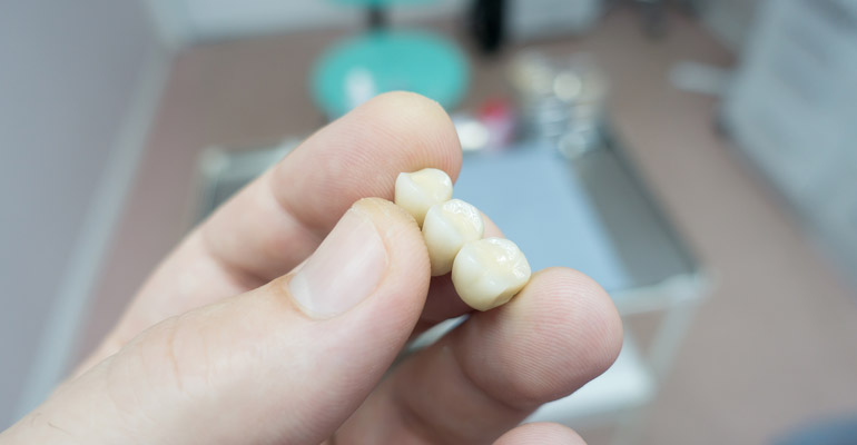 Why Would A Dental Bridge Fail